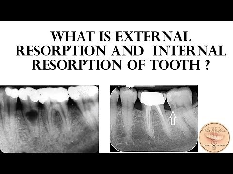 External Resorption and Internal Resorption of Tooth