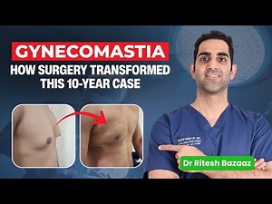 Gynecomastia: 10-Year Case Study, Surgical Approach & Recovery | Explained by Dr Ritesh Bazaaz