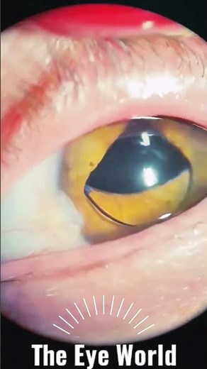 anterior Dislocation of IOL