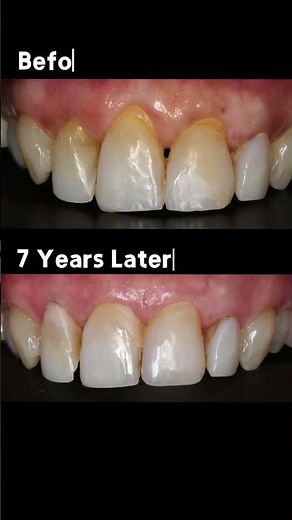 Can Pinhole Really Be Long Lasting? See this 7 Years Case For Yourself! #gumrecession