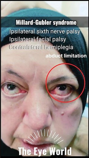 Millard-Gubler Syndrome