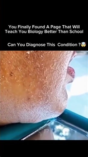 The Shocking Truth About Skin Infestation by Maggots