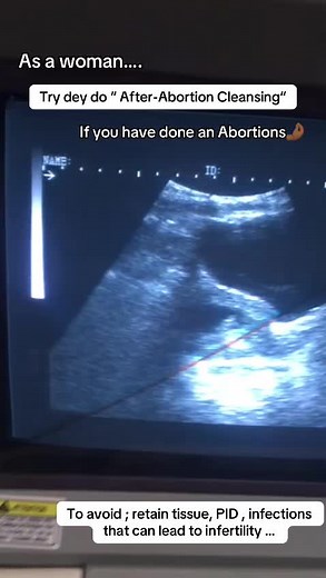 After Abortion Cleansing: Essential Tips and Remedies