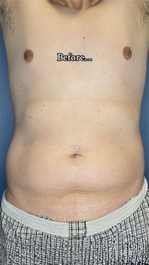 Before & After Body Contouring Results