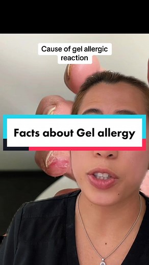 Gel X Allergy: Is It the Product or the Application?