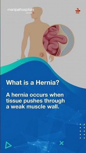 Laparoscopic Hernia Surgery | Procedure, Benefits & Recovery | Manipal Hospitals Kharadi