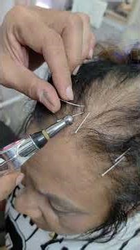 laser Scalp nibs acupuncture for both leg paralysis recovery.#paralysisrecovery #strokerecovery