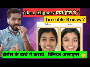 What is Clear Aligner ? Time & Cost | Aligners क्या होते है ? समय और इनका खर्च !