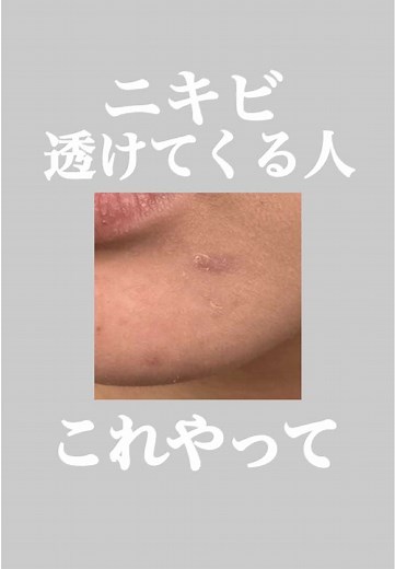 ニキビ跡を隠す！メンズメイクの秘密