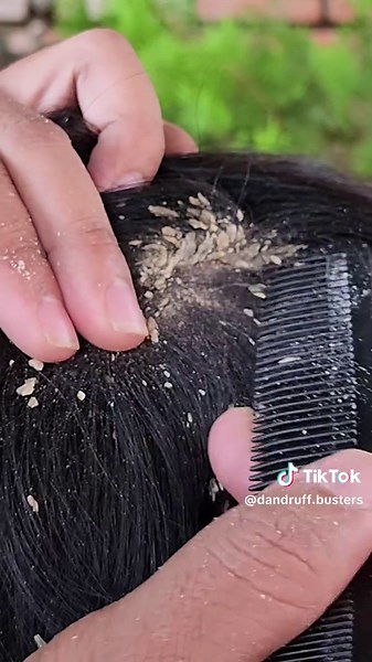Scratching dandruff remove on head #scratching #trending #dandruffscratching #foryou #dandruff