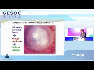 Formas clínicas y diagnóstico de queratitis herpética