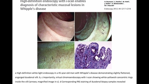 3.8K views · 56 reactions | Unveiling the Subtleties of Whipple's Disease with High-Definition Endoscopy • Recognize the classic endoscopic findings of Whipple’s disease. • Understand the importance of close attention to subtle details in diagnosis. • Learn how high-definition white light and i-scan enhance visualization. Improve your endoscopic diagnostic skills! Explore advanced imaging techniques on EndoCollab. | EndoCollab | Facebook