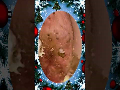 Blackheads Removal | Acne Treatment and Very Satisfying Satisfying Pimple pop #blackheads