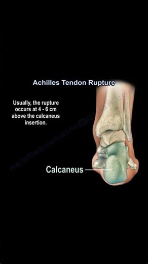 Achilles Tendon Rupture