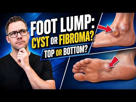 Plantar Fibroma vs. Ganglion Cyst: Which One Is It?