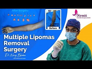Multiple Lipomas Removal Surgery by Dr. Neeraj Bhaban