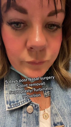 Splint Removal After Nasal Surgery Experience