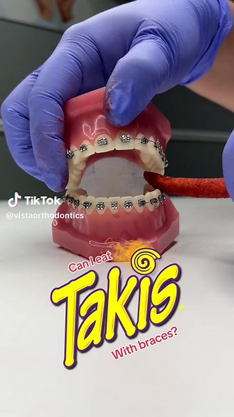 Can I Eat Takis With Braces?
