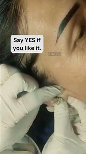 🔥Deep Blackheads, Milia & Whitehead Removal pimple popping New| Big Cystic Acne Extraction#1284 2026