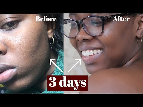 HOW I CLEARED TINY BUMPS/ RASHES ON MY FACE || CLEAR ROUGH AND TEXTURED SKIN - SKINCARE ROUTINE