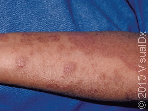Eczema (Atopic Dermatitis) Condition, Treatments and Pictures for Adults