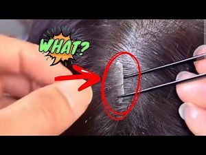 Peeling Off a Dry Dandruff Patch – Unbelievable to See!