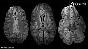 1,000 Times More Detailed than a Standard MRI: 100 Micron Resolution 7 Tesla MRI Scan of the Human Brain. | SurgMedia