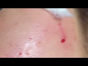 🔥Brutal Cystic Acne Extraction – Real Pimple Popping With Blood | Not for the Faint-Hearted!