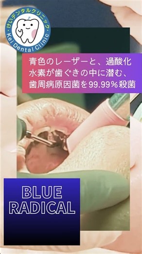 動揺している歯は治る？｜歯周ポケット改善大賞1位のクリニックが行うブルーラジカル施術動画