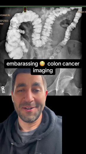 Uncomfortable Barium Enema Test Experience | Colon Cancer Journey