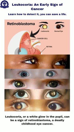 Medicine Master Academy | USMLE on Instagram: "Leukocoria, or "white pupillary reflex," is an abnormal white reflection from the retina, often seen in flash photos or during eye exams. It is most commonly associated with retinoblastoma, a malignant tumor of the retina in young children, but other causes include congenital cataracts, persistent fetal vasculature, Coats disease, retinal detachment, toxocariasis, and retinopathy of prematurity. Prompt evaluation is essential to identify and treat t