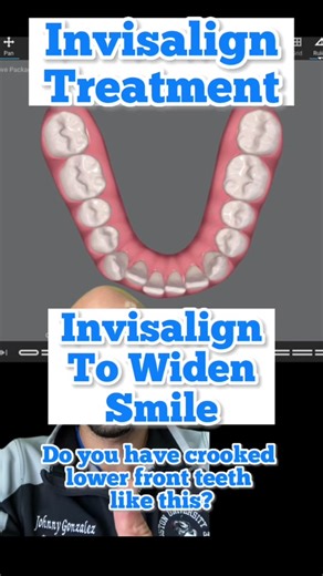 Widen Your Smile with Invisalign for Overcrowded Teeth