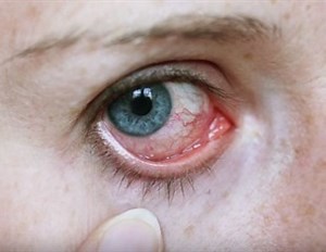 How is Conjunctivitis Diagnosed?