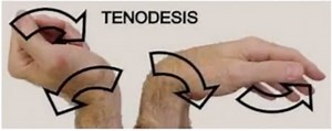 The tenodesis grip is a strategy that many individuals with a high level cervial spinal cord injury use to produce a functional grasping motion with their hands. This allows for the completion of many daily activities to remain within an individuals control including; brushing teeth, manipulating cutlery, holding a water bottle, drawing/painting etc... Check out the short video describing and presenting the tenodesis grip 🔊 Sound on #tenodesisgrip #handfunction #spinalcordinjury #sci #scirecove