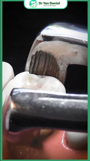 tooth extraction #toothextraction #braces #dentist #viralvideo