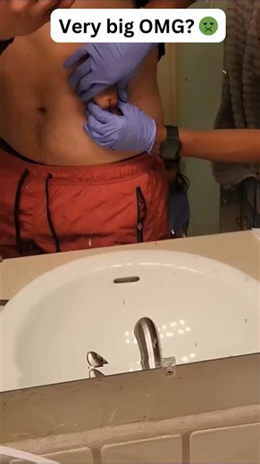 124K views · 267 reactions |  You won't believe what came out of this one... #pimplepop #satisfying | Blackhead Top | Facebook