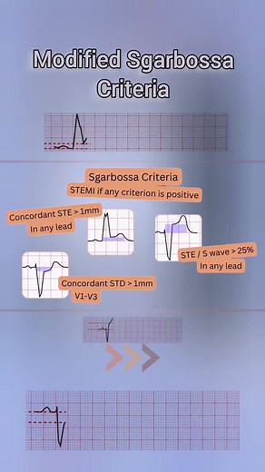 Understanding Modified Sgarbossa Criteria in LBBB/Paced Rhythms 📊❤️ #communitysupport #Cardiology #ECG #SgarbossaCriteria #MedicalResearch #Healthcare | Abdallah Othman