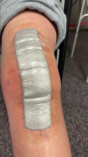 Day 1 of outpatient physical therapy after TKR