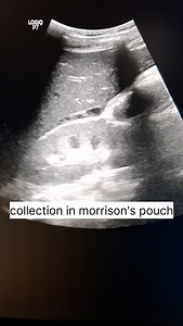 6K views · 756 reactions | Intestinal obstruction #dr_wasi_ultrasound #radiologist #ultrasonography #neetpg #abdominalultrasound #obstruction | Ultrasound made easy | Facebook