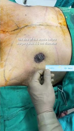 Areola Size After Gynecomastia Surgery | 5 cm to 3.5 cm Result (Part 2)