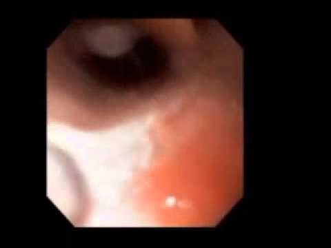 Normal Vocal Cords