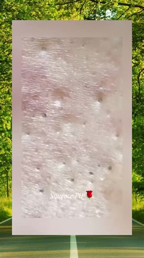 Acne Extraction: Effective Pore Cleansing Techniques