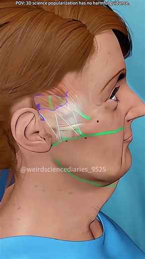 Mini Facelift Surgery #adventure #doctor #3danimation #dentaltreatment #music #anatomy