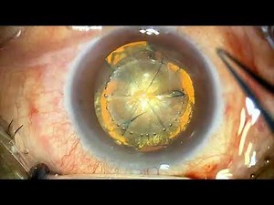 Importance of a good red reflex in combined retina surgery, Proveo 8