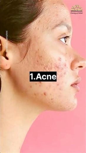 This One Pharmacy Gel Clears Pimples & Dark Spots✅💯