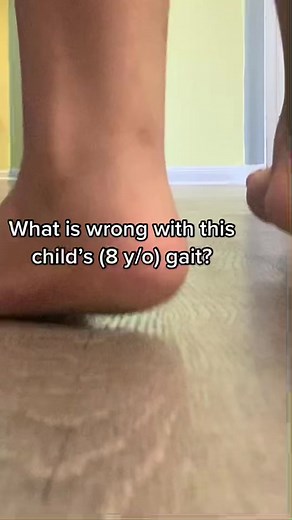 Understanding Gait Analysis in Podiatry