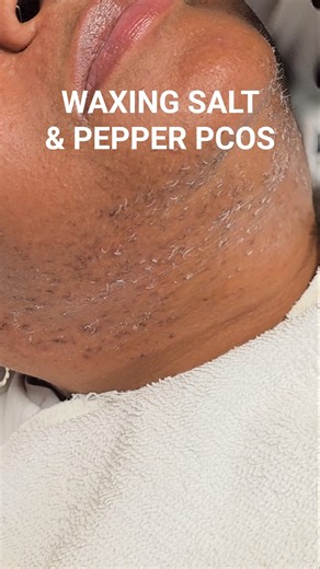 Hirsutism Waxing Gray Hairs #Hirsutism #FaceWax #ChinWax