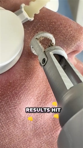 Did you know timing can make a huge difference when it comes to laser resurfacing? January isn’t just another month, it’s one of the most strategic times of the year for treatments like Erbium laser resurfacing. During winter months, UV exposure is lower, which can reduce the risk of post-inflammatory pigmentation while the skin heals. Starting in January also gives the skin several months to remodel collagen internally before stronger sun exposure returns. Recovery tends to feel more manageable