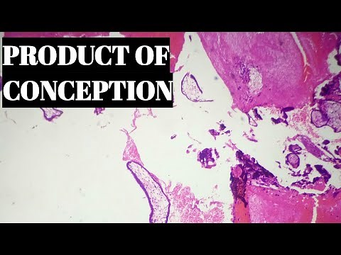 Product Of Conception Histopathology