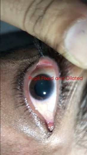 pupil fixed and Dilated #medicine #pupil #eye